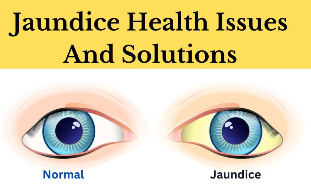 Jaundice Health Issues And Solutions